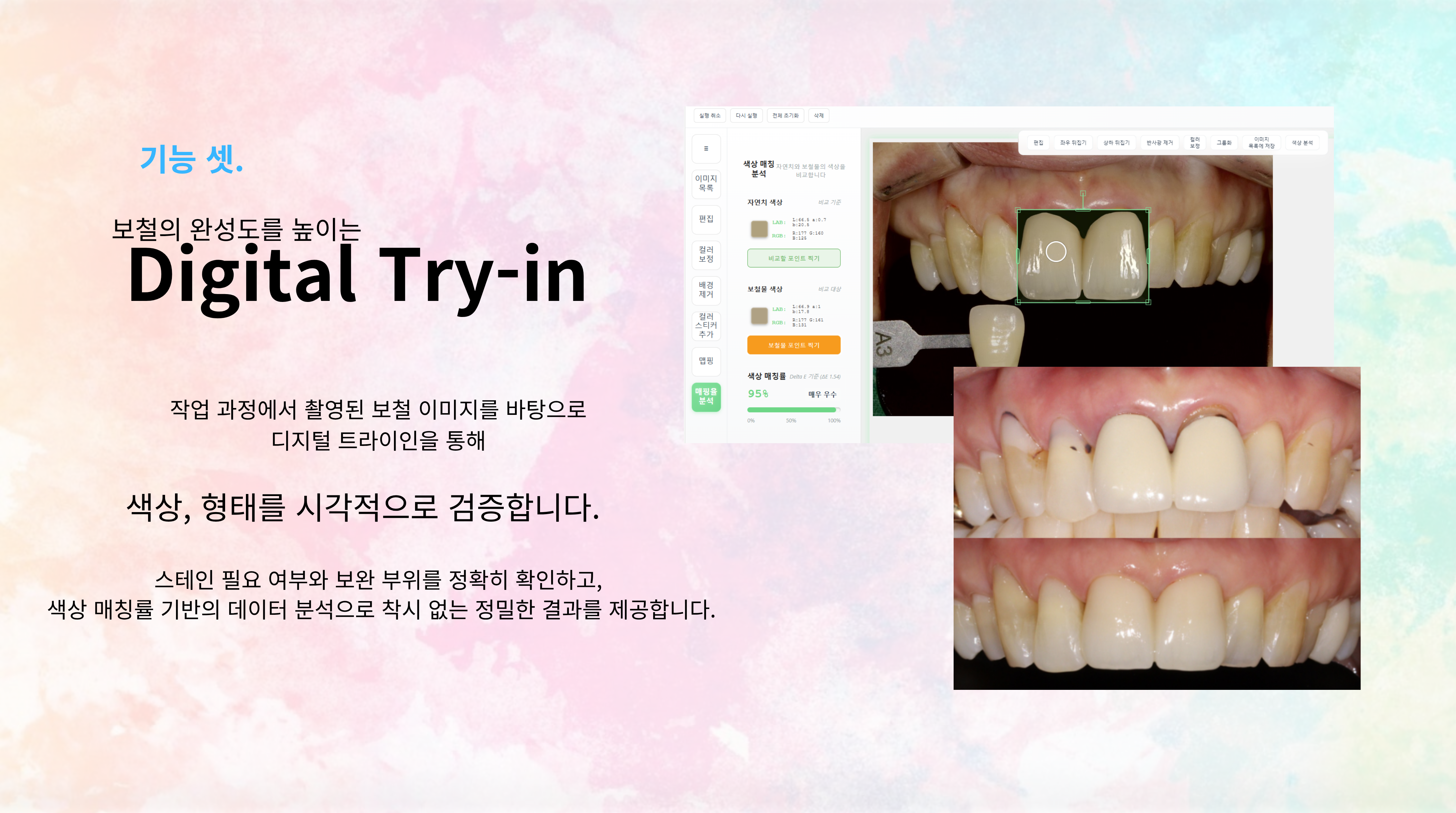 DentPalette - AI 쉐이드 매핑 솔루션